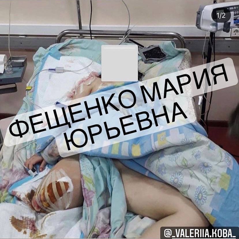 В Запорожской области мама с дочерью попали под обстрел и обе потеряли ноги